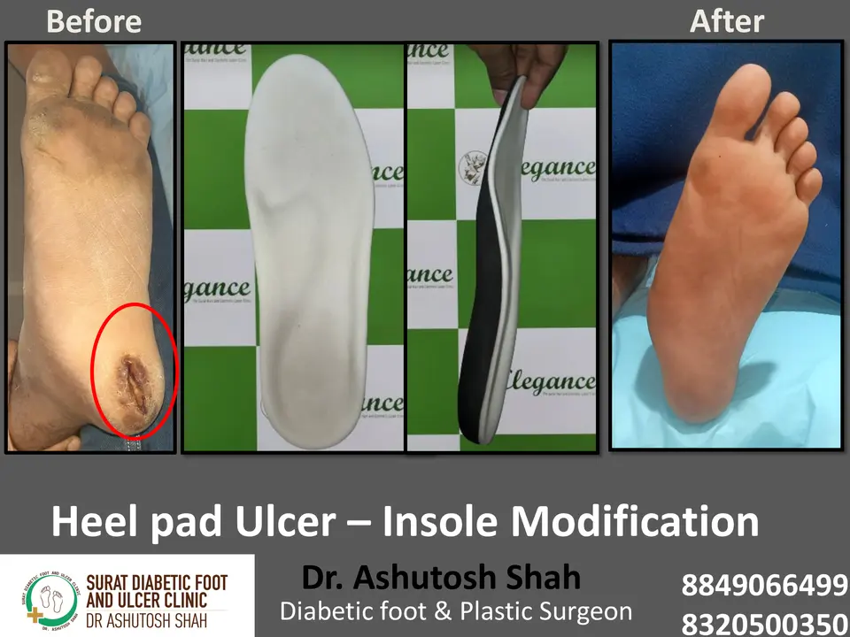 Diabetic Foot  PPT 3 checked by sir.pptx-37.webp